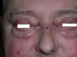 Klinische casus: een ‘oedeem’ van de oogleden met een onverwachte oorzaak