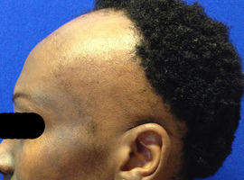Inzending mooiste beeld: een eigenaardige 'alopecia areata'