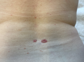 Dermoscopie: Avez-vous vu les stries?