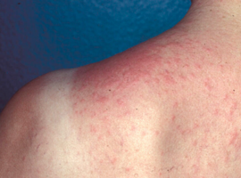 Immunologisch gemedieerde fotodermatosen