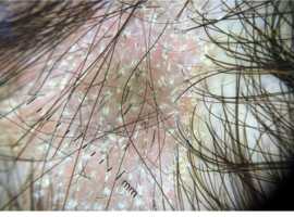 Dermatoscopie: Met de haren in het haar