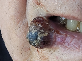 Klinische casus: snelgroeiende massa op de onderlip
