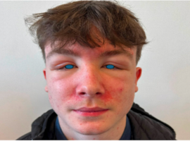 La plus belle image: un œdème inattendu