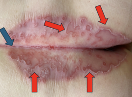 Het mooiste beeld: een perianale uitslag