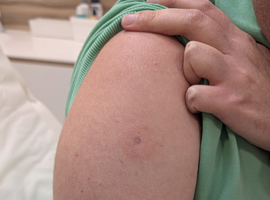 Het mooiste beeld: scleroedema diabeticorum