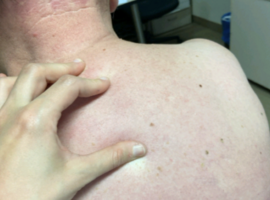 La plus belle image: sclérœdème diabétique