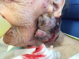Épidémiologie et aspects cliniques des cancers cutanés chez les patients greffés d’organe ou de moelle