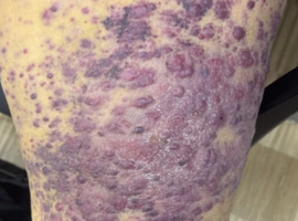 Het mooiste beeld: Stewart-Treves syndrome