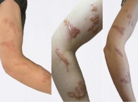 Het mooiste beeld: door te wrijven wordt het erger!