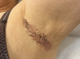 Het mooiste beeld: Jeukende oksellaesies: Granulaire Parakeratose als onderbelichte oorzaak