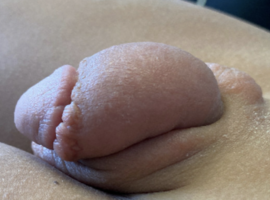 Recurrent penoscrotaal oedeem bij een pediatrische patiënt