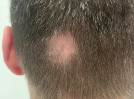 Klinische casus: Alopecic and aseptic nodules of the scalp