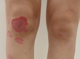 Tinea incognito versus annulaire pustuleuze psoriasis: een diagnostische uitdaging