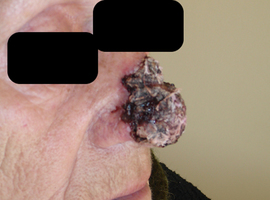 Recidief van basocellulair carcinoom behandeld met immunocryochirurgie