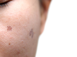 Coup d'envoi de la campagne Euromelanoma, qui dépiste gratuitement le cancer de la peau