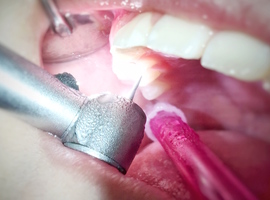 L'Europe veut supprimer le recours au mercure en dentisterie