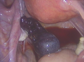 Section tubaire spontanée et torsion tubaire isolée: à propos de trois situations cliniques