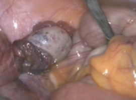 Ovariële torsie op een normale eierstok op 20 weken zwangerschap