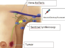 De invloed van axillary reverse mapping op de incidentie van borstkankergerelateerd lymfoedeem