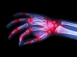 Behandeling van artritis: een echte revolutie in de reumatologie 