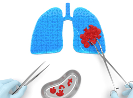 Cancer du poumon non à petites cellules et radiothérapie stéréotaxique