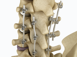 La technologie informatique au secours de la chirurgie du dos à l'UZ Brussel