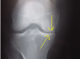 Définition et classification de l’arthrose précoce du genou