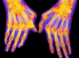 Aanhoudende remissie in reumatoïde artritis: niet eenvoudig