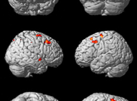 TDAH: implication d’une connectivité entre le cervelet et le noyau rouge?