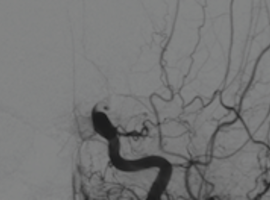 Mechanische trombectomie na mislukken van intraveneuze trombolyse bij een acuut ischemisch CVA 