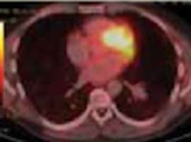 Mediastinale klierstagering van longkanker: nieuwe concepten