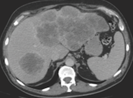 Oncologische aanpak van niet-reseceerbare levermetastasen