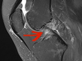 Au sujet de l’article «Traitement des lésions du ligament croisé antérieur: faut-il toujours opérer?» de Delincé et Ghafil (ortho-rhumato.be, le 26-09-12)