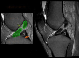 Le traitement des lésions du ligament croisé antérieur du genou est-il nécessairement chirurgical?