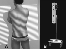 Une technologie innovante pour le suivi de certaines pathologies du dos: la morphométrie optique