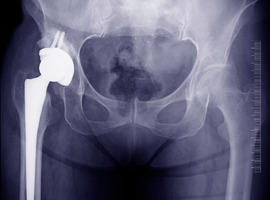 Réduction de l’incidence des fractures de hanche: un premier pas, mais insuffisant!