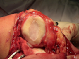 La place de l’implantation de chondrocytes autologues dans l’articulation fémoro-patellaire