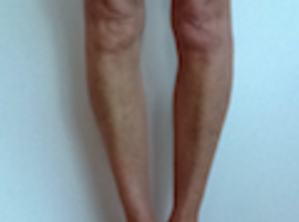 Fracture de stress bilatérale simultanée du plateau tibial médial chez une femme d’âge moyen