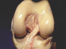 Le ligament antérolatéral du genou