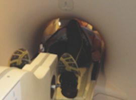 Functievermindering van de rechterventrikel op het einde van een intensieve duurwedstrijd: nieuwe inzichten met inspannings-MRI