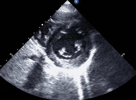 Screenen voor pulmonaire arteriële hypertensie en sclerodermie 