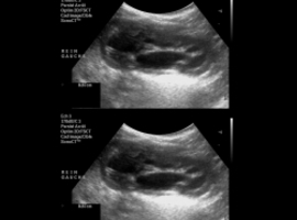 Vesico-ureterale reflux: wanneer een retrograde cystografie uitvoeren?