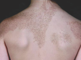 Schéma de diffusion du vitiligo segmentaire: pistes de mosaïcisme somatique*