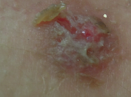 Pemphigus vulgaire ou paranéoplasique?