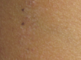 Dermatose linéaire photosensible 