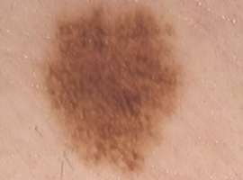 Melanoma in situ 