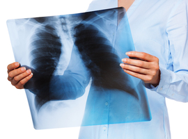 Is pneumonie een risicofactor voor hartfalen?