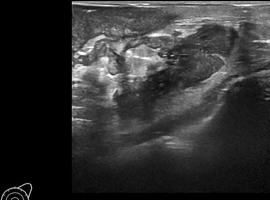 Idiopathische granulomateuze mastitis: een moeilijk probleem