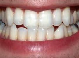 Ongezien: regering verlaagt grens inwerkingtreding om tariefakkoord tandartsen te redden