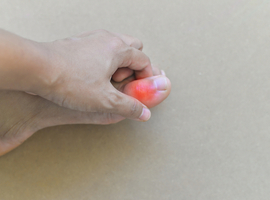 Une tuméfaction douloureuse des tissus mous au niveau du pied? Pensez toujours à la goutte!